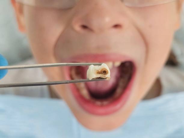 Best Broken or Cracked Tooth Emergency Dentist in Santee, CA